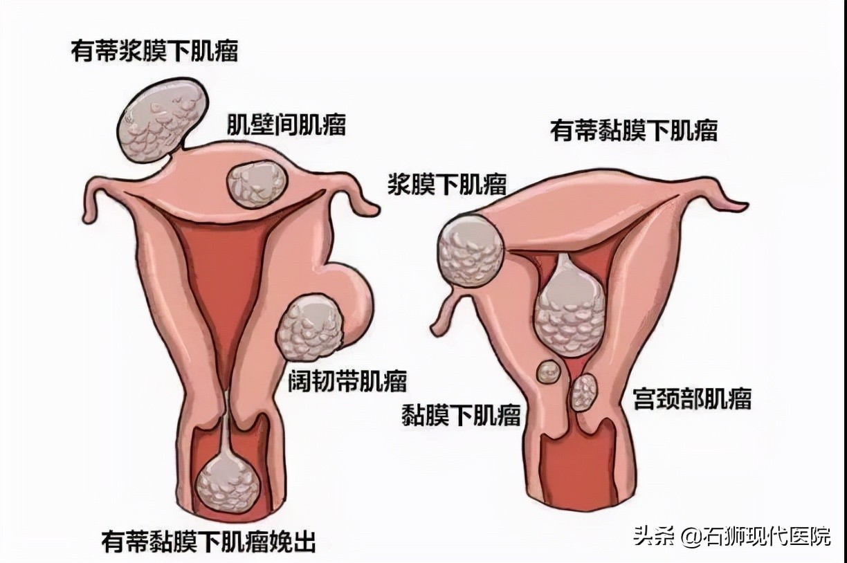 怕怕怕！听说5个女人就有1个得子宫肌瘤？