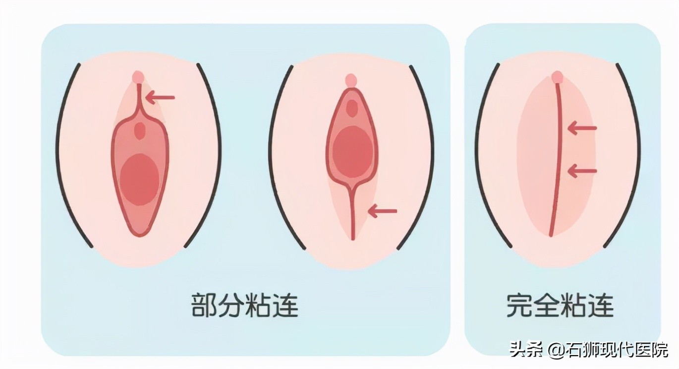 阴唇粘连？“假性月经”？分泌物……你担心的问题都有答案了