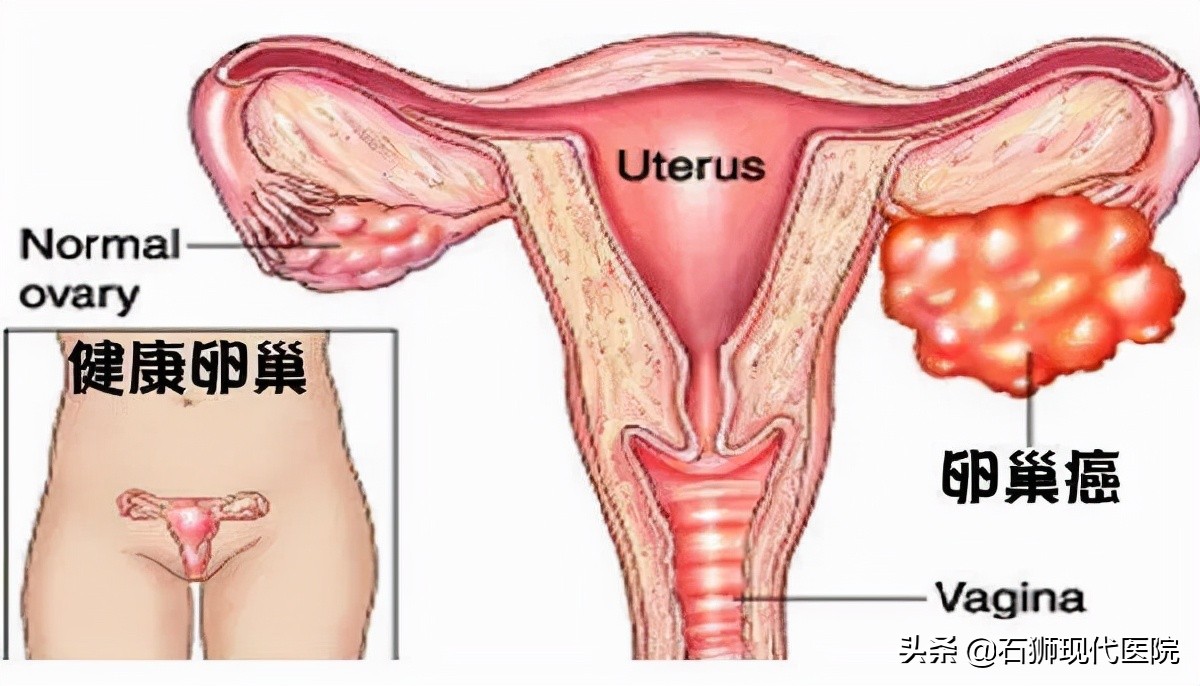 20多岁女孩肚子痛查出卵巢囊肿，没有X生活为啥还会得妇科病？