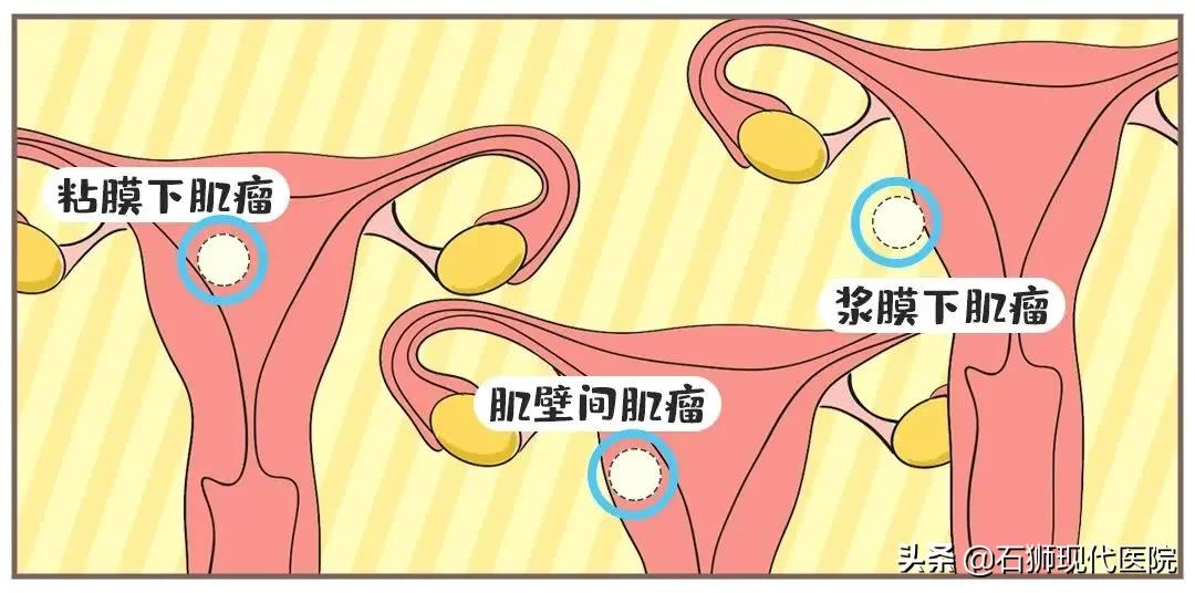 大家好,我是一枚10岁的子宫肌瘤