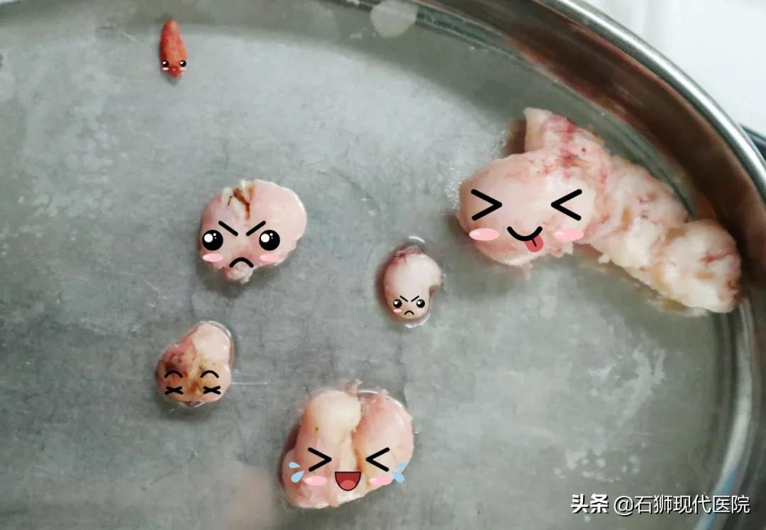 大家好,我是一枚10岁的子宫肌瘤