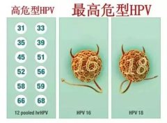 妇科医生又催我做“HPV+TCT”检查，真的