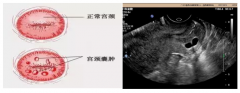体检超声查出“宫颈囊肿”、“卵巢囊