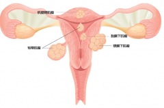 子宫肌瘤的6个特点，如果你有赶紧到医