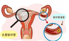 输卵管检查，那几种情况需要？看完才