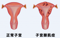 健康科普 | 经期痛经、月经量多，可能