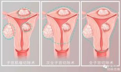 发现子宫肌瘤一定要手术切除吗？