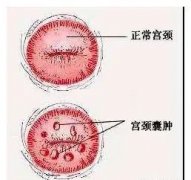 宫颈囊肿严重吗？