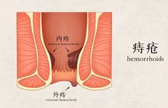 怕尴尬，不治疗？女性患上痔疮的危害