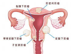 得了多发子宫肌瘤怎么办?只能“挖呀挖