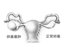 卵巢囊肿是良性还是恶性？