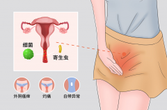 细菌性阴道炎？不要怕，石狮现代医院