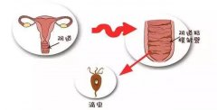 阴道里长了“虫”？滴虫性阴道炎该如