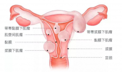 查出子宫肌瘤，要手术么？