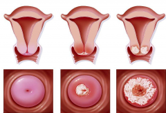 宫颈炎都有哪些危害？你要知道！