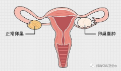女性为什么会患上卵巢囊肿？有这几种